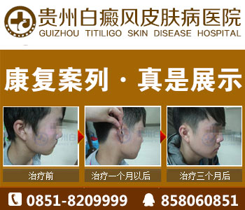 初步诊断白癜风疾病的方法