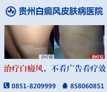 白癜风皮损的地方为什么会出现瘙痒